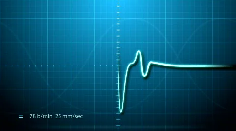 EKG - Electrocardiogram Stock Footage 600200
