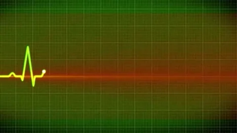 EKG loop Stock Footage 98247177