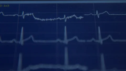 EKG machine  Stock Footage 129731579