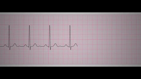 Ekg Normal Sinus Rhythm Stock Footage 112644709