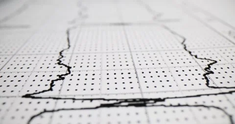 EKG or EKG graph showing a patient's heart rate and electrical activity Stock Footage 266779247