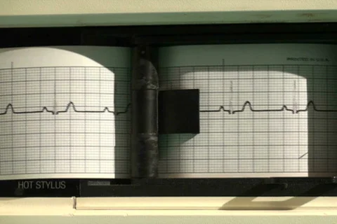 EKG printer flatline - NTSC Stock Footage 680615
