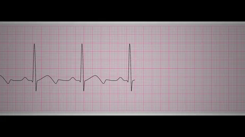 Ekg Sinus Bradycardia Video stock 112644962