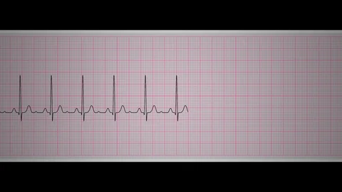 Ekg Sinus Tachycardia Video stock 112645038