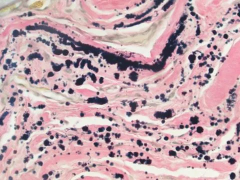 Elastofibroma-elastic stain Stock Photos