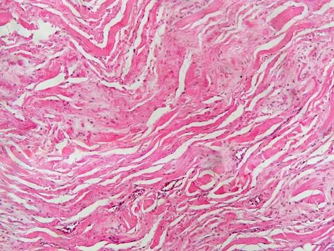 Elastofibroma-soft tissue tumor Stock Photos