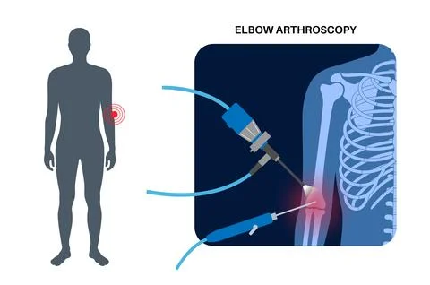 Elbow arthroscopy surgery Stock Illustration