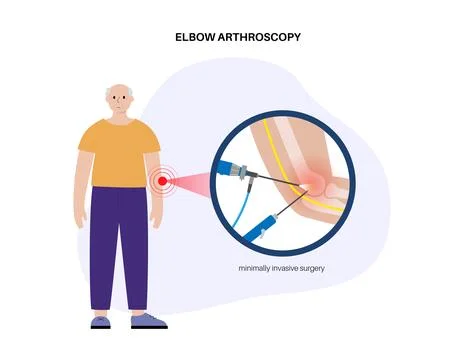Elbow arthroscopy surgery Stock Illustration