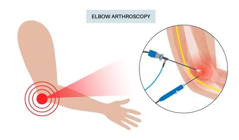 Elbow arthroscopy surgery Stock Illustration