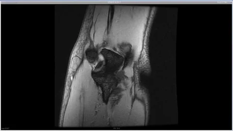 Elbow bursitis diagnosis Stock Footage 84512956