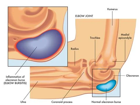 Elbow bursitis Stock Illustration
