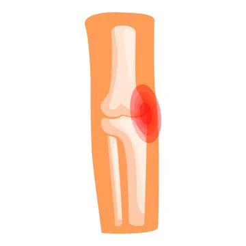 Elbow joint inflammation causing pain, medical illustration Stock Illustration