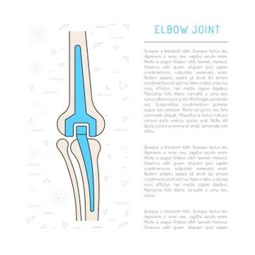 Elbow joint prosthesis Stock Illustration