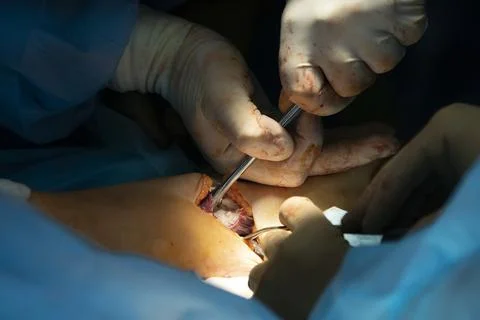 Elbow Joint Surgery Photos