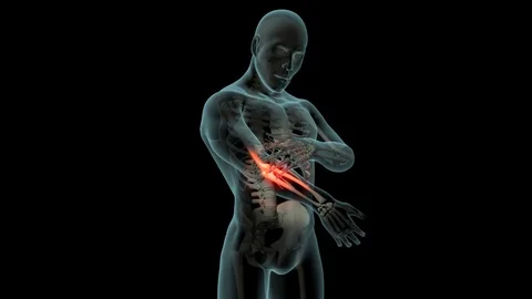 Elbow Pain Stock Footage 121790241