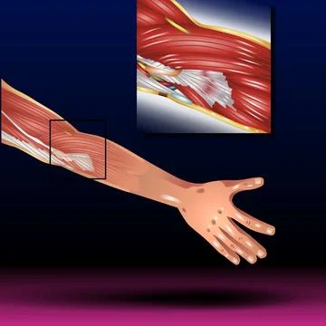 Elbow Tendonitis Stock Illustration