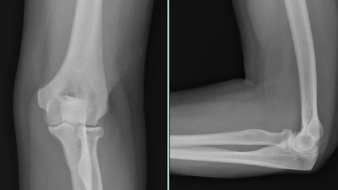 Elbow X-rays are normal skeleton Vídeo Stock 111647534