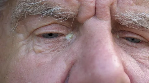 Elderly man with blepharitis eye infection blinking slowly Stock Footage 338441435