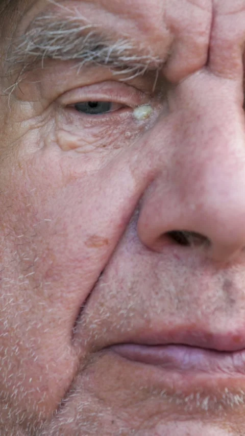 Elderly man with blepharitis eye infection blinking slowly Stock Footage 342815061