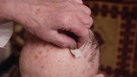 An elderly senior is treated with the surface of the head Stock Footage 139770595