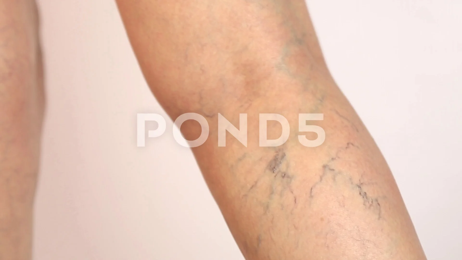 An elderly woman in white panties shows places on the body with cellulite  and varicose veins on a bright isolated background. A concept for medicine  and cosmetology. Stock Photo