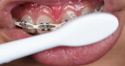 Electric brushing around braces  Stock Footage 286762327