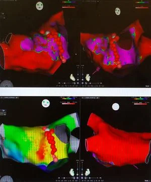 Electrical Mapping of the Left Atrium - Radiofrequency Ablation for SVT Stock Photos