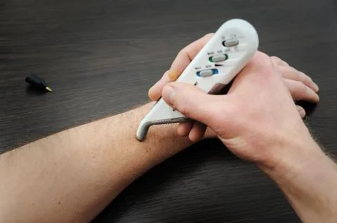 Electro Acupuncture session. Stock Photos