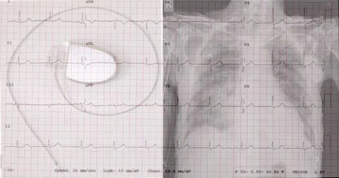 Electrocadiogram of wave in paper report. Stock Photos