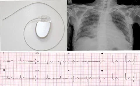 Electrocadiogram of wave in paper report. Stock Photos