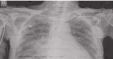 Electrocadiogram of wave in paper report. Stock Photos