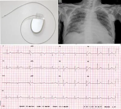 Electrocadiogram of wave in paper report. Stock Photos