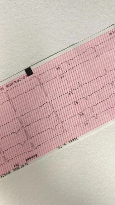 Electrocardiogram checkup analysis on a paper tape representing human heart.. Stock Footage 345552828