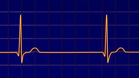 Electrocardiogram ECG displaying a junctional rhythm, 3D illustration Stock-Illustration