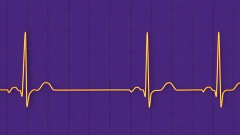 Electrocardiogram ECG displaying sinus arrhythmia, 3D illustration Illustrazione stock