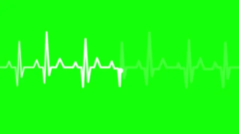 Electrocardiogram ECG Heartbeat Pulse Animation on Green Screen Vídeos de archivo 315014654