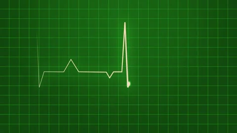 Electrocardiogram. ECG Loop. Video stock 313074169