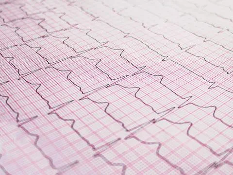 Electrocardiogram example of a normal 12-lead sinus rhythm Stock Photos