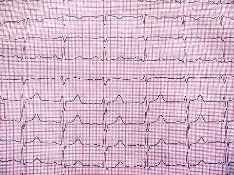 Electrocardiogram example of a normal 12-lead sinus rhythm, close up Stock Photos