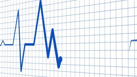 Electrocardiogram heartbeat trace animation background Stock Footage 329115835