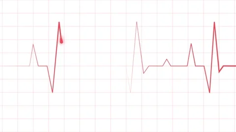 Electrocardiogram line heartbeat trace with sharp peaks and minimal design .. Stock Footage 340387227