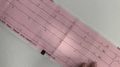 Electrocardiogram paper checkup representing human heartbeat rhythm. Medica.. Stock Footage 346161082