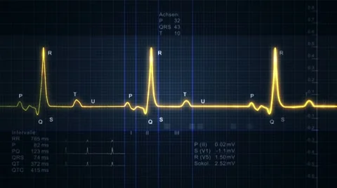 Electrocardiogram - pulse trace Stock-Footage 8647332