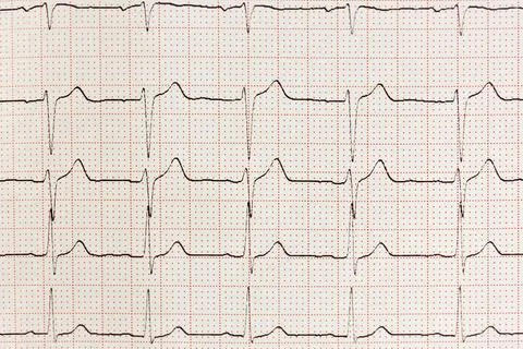 Electrocardiogram Result Stock Photos
