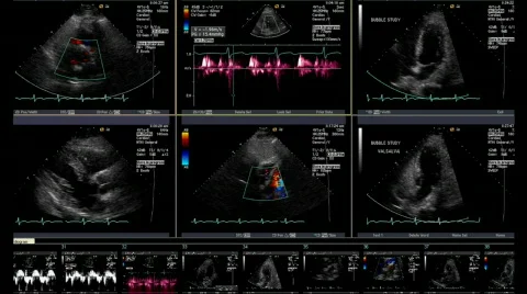 Electrocardiogram screen capture Stock Footage 290239