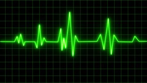 Electrocardiogram show (STEMI) pattern. Heart attack. Ischemic. Coronary ar.. Stock Illustration