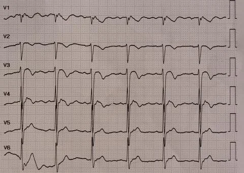 Electrocardiogram showing multiple leads with inverted T waveforms in V1- t.. Stock Photos