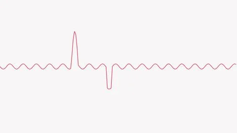 Electrocardiogram spike pattern showing heart rhythm disturbance on white b.. Stock Illustration