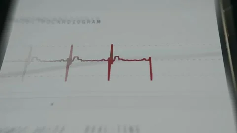 Electrocardiogram waveform interface performing cardiovascular monitoring Video stock 335888280
