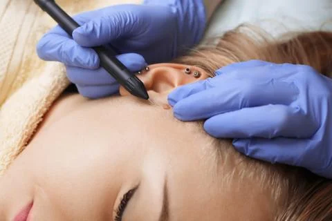 Electrocoagulation of vessels on the face Foto stock